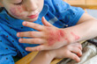 A child's hand scratching a red, bumpy skin rash,  discomfort and irritation caused by dermatitis.
