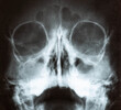 X-ray image of the skull of a child with purulent sinusitis, close-up. Treatment of inflamed sinuses, purulent secretion
