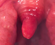 Long uvula with inflammation of infections and viruses. Treatment of uvulitis in children and adults. Sore throat, sore throat, macro. Allergy