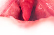 Long uvula with inflammation of infections and viruses. Treatment of uvulitis in children and adults. Sore throat, sore throat, macro