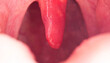 Red, inflamed and swollen uvula in the throat. Treatment of uvulitis due to bacteria and streptococcal viruses. Otolaryngology, macro