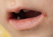 slit-like impetigo in a little girl in the corners of her mouth. Skin wounds. Dermatological bacterial disease. Sticky lips, close-up, angulitis