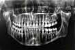 Panoramic x ray reveals multiple impacted teeth in upper and lower jaw
