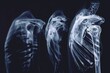 This photo showcases three X-ray images that reveal the skeletal structure of a human back, Art outlining progression of a shoulder dislocation, AI Generated