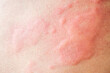 © Kwangmoozaa - Skin allergy rash dermatitis texture close up background