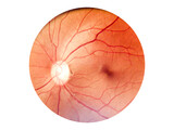 Fototapeta Łazienka - Patient elderly with retina of diabetes.Human eye anatomy taking images with Mydriatic Retinal cameras.