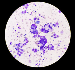 Poster - Malignant fluid cytology; Cells of adenocarcinoma may spread to fluid of pleural or peritoneal cavity in cancer from the breast, lung, colon, pancreas, ovary, endometrium or other sites.