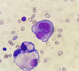 Canvas Print - Malignant fluid cytology; Cells of adenocarcinoma may spread to fluid of pleural or peritoneal cavity in cancer from the breast, lung, colon, pancreas, ovary, endometrium or other sites.