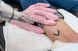 © Alan - close up of Cosmetic tattoo removal treatment by professional: laser procedure for ink removal