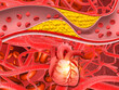 Cholesterol in human heart, Clogged blood vessels,3d illustration...