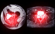 MRI of the prostate gland reveals Focal abnormal SI lesion at left PZpl at apex as described; PI-RADS category 4, clinically