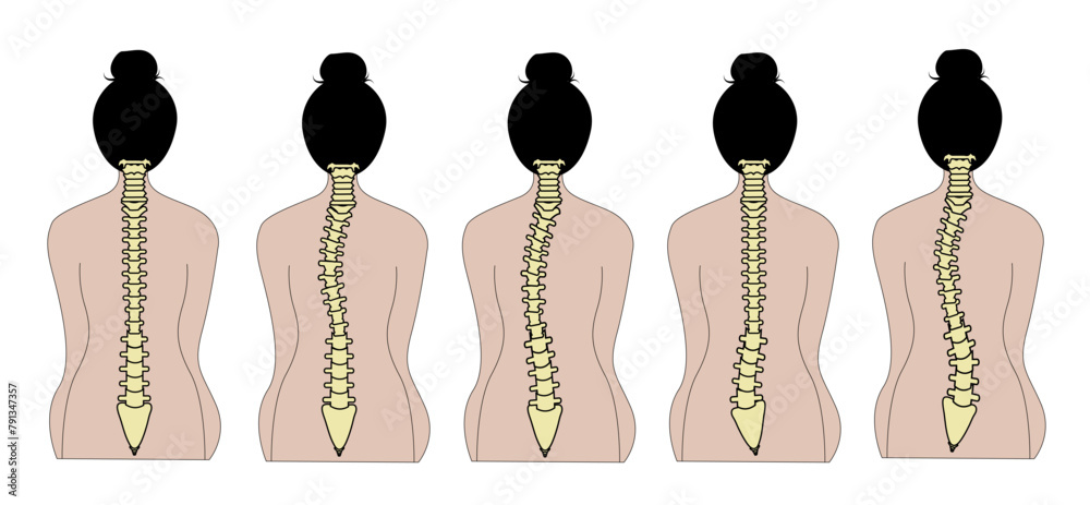 Abnormal Back Types of scoliosis, spine curvature deformity, human spinal backbone ...