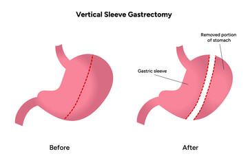 Vertical Sleeve Gastrectomy 