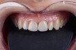 Macro photography of teeth with veneers