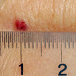 Measurement of a liver spot (pigment nevus) 