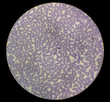 Microscopic (Magnification) of human blood, Hematologic disease.