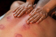 Close-up of the masseur's hands on the man's back with traces of vacuum therapy. Alternative medicine. Massage with vacuum cups.