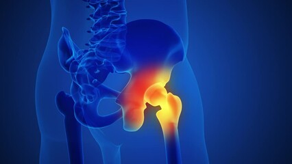 Wall Mural - Painful hip joint with blue background