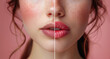© Ekaterina - Comparison before and after lip filler injections or permanent lips make up on pink background.