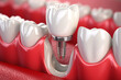 Dental Crown Placement: Image showing the placement of a dental crown to restore a damaged or weakened tooth.
