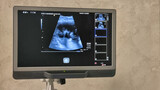 Fototapeta  - ultrasound monitor with fetus pictures, ultrasound equipment with baby pictures, medical examination of the body of the pregnant woman patient