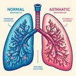 Normal vs asthmatic bronchioles, illustration. Lungs vector illustration comparison background for lungs. world lungs day & health day poster or social media ads design created with generative ai	