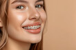 Close up of a woman smiling while wearing orthodontic braces on her teeth