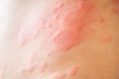 © Kwangmoozaa - Skin allergy rash dermatitis texture close up background