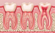 An illustration depicting the progression of periodontitis, with stages ranging from healthy gums to severe inflammation and gum recession