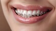 Radiant Confidence Close-Up of Beautiful Female Smile with Straight White Teeth and Braces
