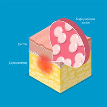 3D Isometric Flat Vector Illustration Of Cellulitis, Bacterial Infection