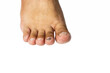 Hematoma formation on the toenail caused by being hit by a hard object.
