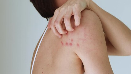 Wall Mural - A woman scratches her shoulder bitten by a bedbug on a white background, close-up. Skin health problem. Red pimples.