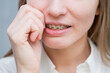 Close-up portrait of a red-haired girl suffering from pain due to braces. Young woman corrects bite with orthodontic appliance.