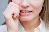 Fototapeta Zwierzęta - Close-up portrait of a red-haired girl suffering from pain due to braces. Young woman corrects bite with orthodontic appliance.