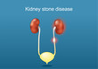 Kidney stone disease