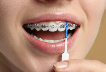 Woman with dental braces cleaning teeth using interdental brush, closeup