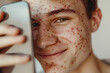 Portrait of young boy with scar or acne on face skin generative AI