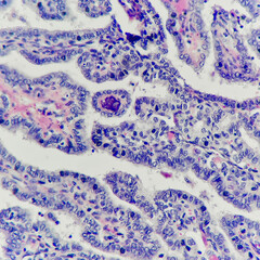 Camera photo of papillary thyroid carcinoma showing psammoma bodies, magnification 400x, photograph through a microscope