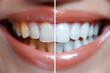 female open mouth with smile with healthy white teeth before and after dental whitening