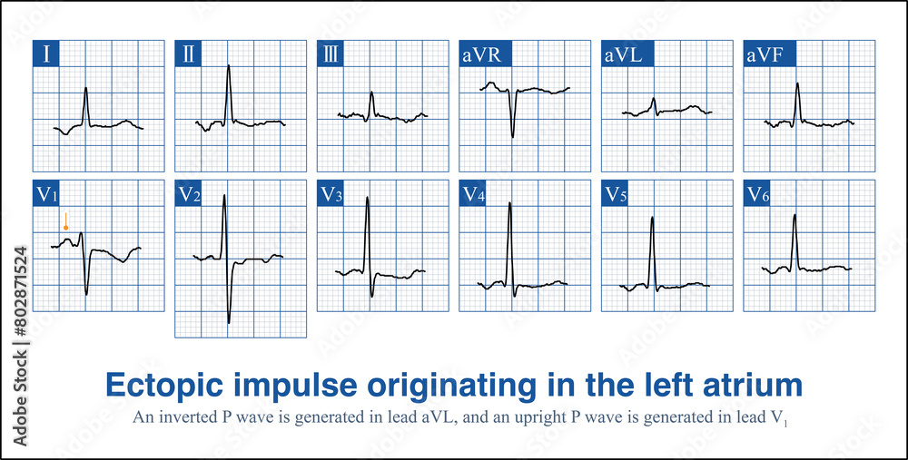 When ectopic impulses from the anterior wall of the right atrium