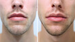 © Mehran - Before and after photos show the difference in a man's lips after getting lip injections.