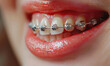Braces on the teeth, close up shot