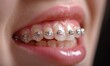 Braces on the teeth, close up shot
