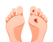 © Maman - Diabetic foot ulcers vector isolated on white background.