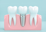 Fototapeta Kuchnia - Dental implants on light blue background