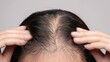 © Oulaphone - Hair loss concept. Close up of hands holding and running fingers through hair, highlighting signs like thinning or sparse bald spots on top of the head in patterned hair loss on white background.