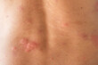 Young asian man itching and scratching on his back from allergic itchy dry skin eczema dermatitis insect bites
