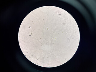 calcium oxalate crystal in urine.