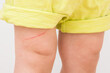 Abrasion leg skin of toddler. Isolated on light gray background. Closeup. Front view.